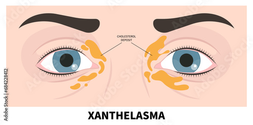 Eyelid skin with fatty deposits that the name in medical called Xanthelasma disease photo