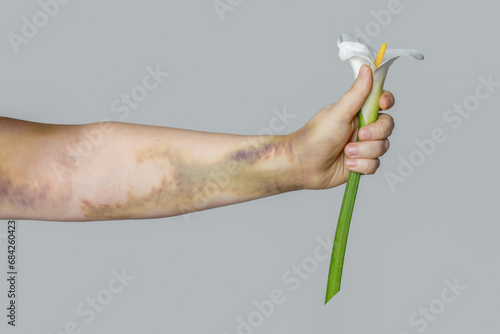 Woman hand with bruise holding white flower close up on gray background. Car accident scar or pulmonary embolism treatment