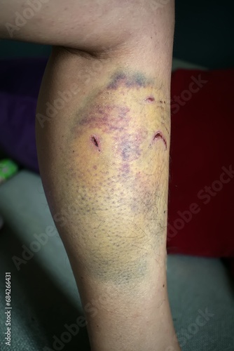 dog bite on leg with hematoma