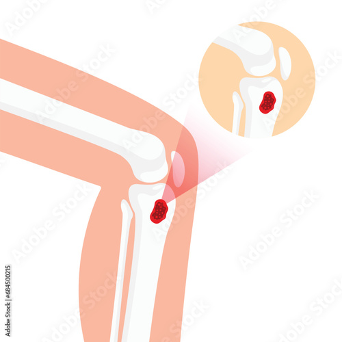 Osteomyelitis Disease Illustration for Medical