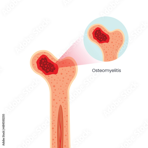 Bone Osteomyelitis Vector Illustration
