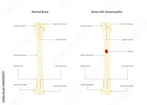 Normal Bone and Bone with osteomyelitis