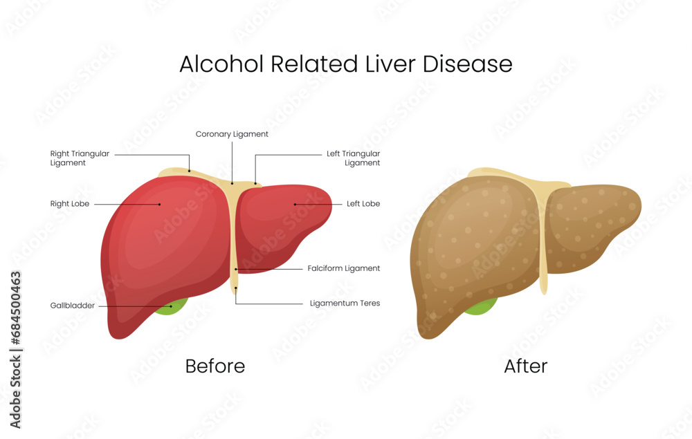 Illustration of Alcohol Related Liver Disease Vectors
