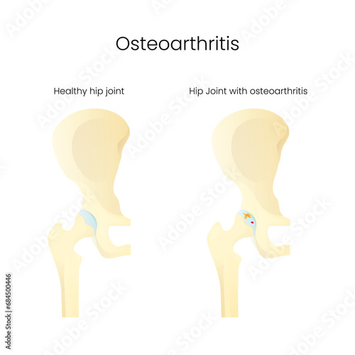 Hip Joint Healthy and Hip Joint Osteoarthritis Disease