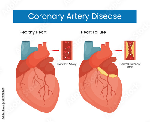 Coronary Heart Disease Information