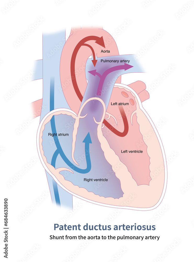 Naklejka The aorta shunts to the pulmonary artery through the arterial ...