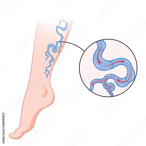 Varicose veins. Blue blood vessel visible through the skin, abnormally swollen leg. Vascular disease diagnostic and treatment. Venous insufficiency medical disease