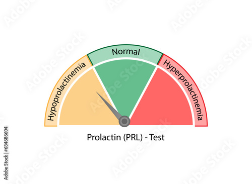 Prolactin hormone. Prolactinoma, Benign tumor, adenoma. Hyperprolactinemia. Hypoprolactinemia,. Healthcare. Vector illustration.