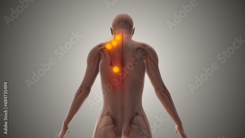 Myofascial referred pain and trigger points