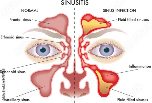 Medical  illustration of symptoms of Sinusitis. photo