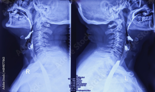 Barium swallow of oesophagus examination x-ray. showing upper digestive system. Oesophagus, mucosal pattern of oesophagus, Normal findings. photo