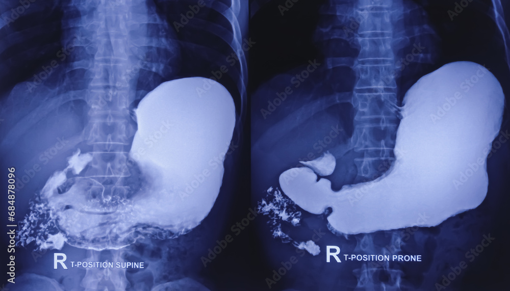 Barium swallow of oesophagus examination x-ray. showing upper digestive system. Oesophagus, mucosal pattern of oesophagus, Normal findings. - obrazy, fototapety, plakaty 