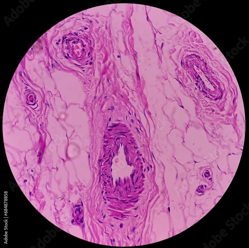 Distal femur (biopsy): Exostosis. Section show mature hyaline cartilage with overlying fibrous perichondrium. photo