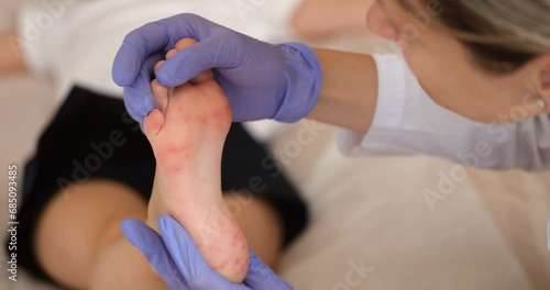 Doctor conducts a medical examination and childb legs with red allergic spots. Enterovirus coxsackie skin red rash insect bites or covid infection photo