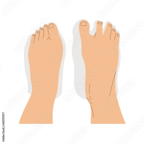 Top view comparison of healthy and deformed feet after wearing regular and barefoot shoes. 