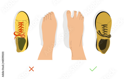 Top view comparison of healthy and deformed feet after wearing regular and barefoot shoes. Shoes, sneakers traditional and orthopedic.