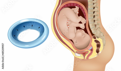 Gynecological and obstetric pessary. Cervical pessary in pregnant women with a short cervix. Modeling of effective positioning of Arabin cerclage pessary in women at high risk of preterm birth. photo