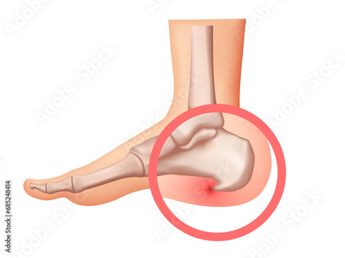 Heel spur illustration. Design elements on the theme of plantar fasciitis. Vector set.