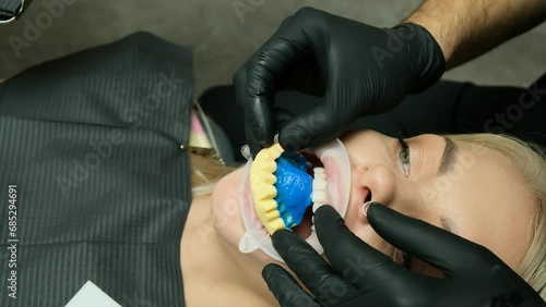 The dentist removes the denture mold from the girl's upper jaw. Orthodontist treatment in dentistry, dental prosthodontics prosthetics. Taking impressions to create veneers. Close-up. photo