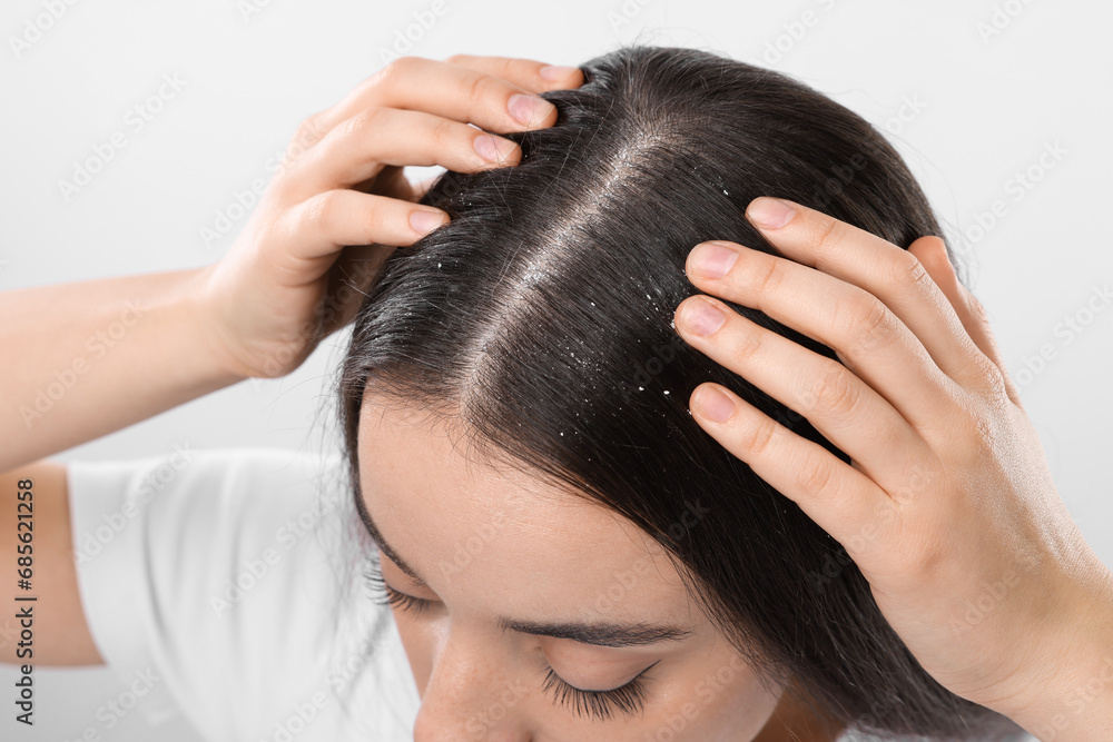 Fototapeta premium Woman with dandruff problem on white background, closeup
