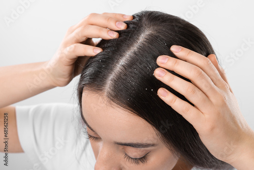 Woman with dandruff problem on white background, closeup