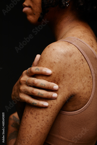 Young woman with acne scars against black background photo
