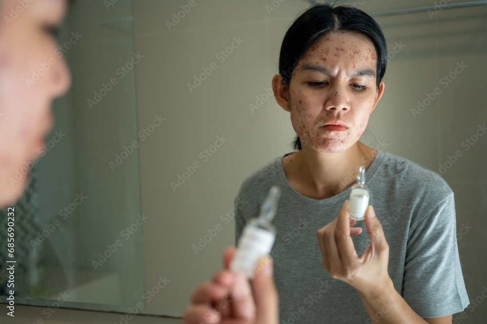 Acne on face because the disorders of sebaceous glands productions