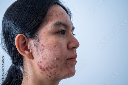 Acne on face because the disorders of sebaceous glands productions.  Acne or a Cosmetic Allergy. Hormonal changes and Foods Cause Symptoms of Skin Allergies photo