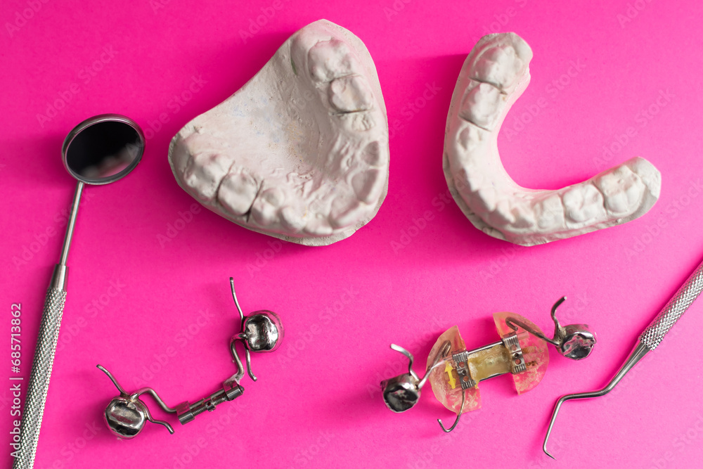 Dental casting gypsum model of human jaws. Crooked teeth and distal