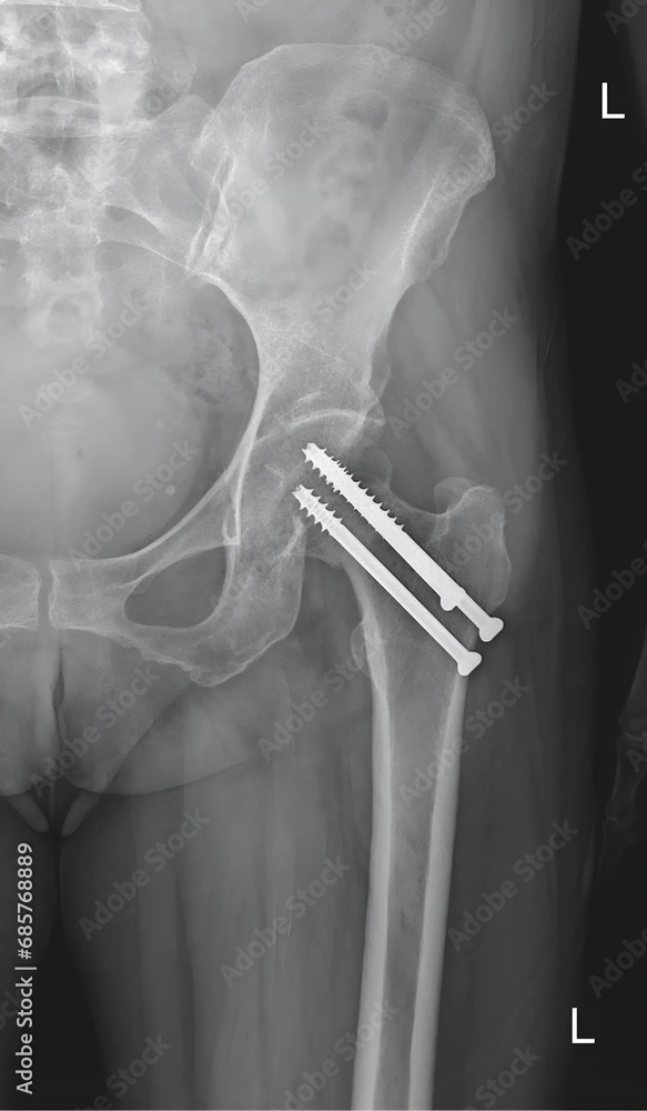 X Ray Image Of The Hip Joint With Fracture Fixation Using Screws Provides A Visual Record Of The 9630