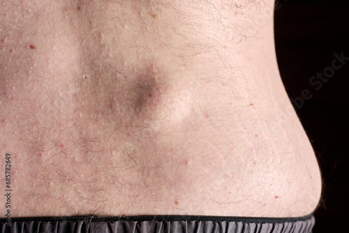 Small round lipoma on the lower back of young caucasian man against dark black background photo