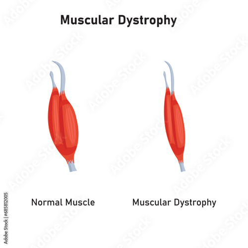 Duchenne Muscular Dystrophy (DMD) Scientific Design. Vector Illustration.