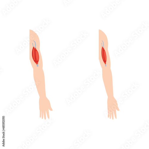 Duchenne Muscular Dystrophy (DMD) Scientific Design. Vector Illustration.