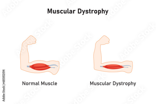 Duchenne Muscular Dystrophy (DMD) Scientific Design. Vector Illustration.