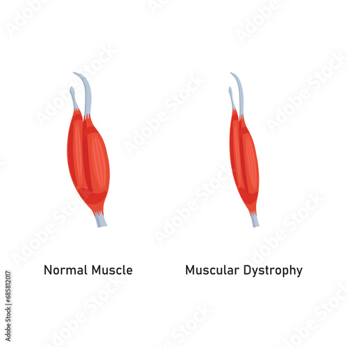 Duchenne Muscular Dystrophy (DMD) Scientific Design. Vector Illustration.