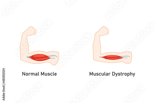 Duchenne Muscular Dystrophy (DMD) Scientific Design. Vector Illustration.