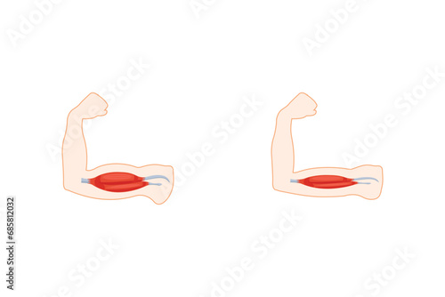 Duchenne Muscular Dystrophy (DMD) Scientific Design. Vector Illustration.