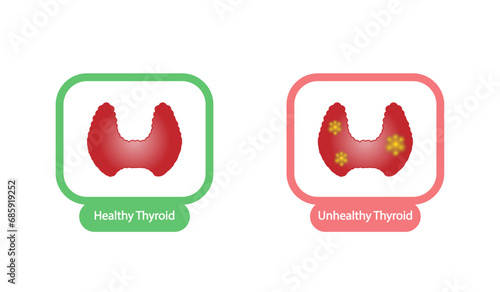Healthy Thyroid gland and unhealthy thyroid with Inflammation and lump, thyroid cancer. Vector illustration isolated on white background.