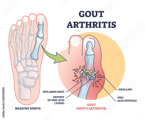 Gouty arthritis with inflamed toe joint painful condition outline diagram. Labeled educational scheme with medical disease and foot swelling from uric acid crystals deposition vector illustration.