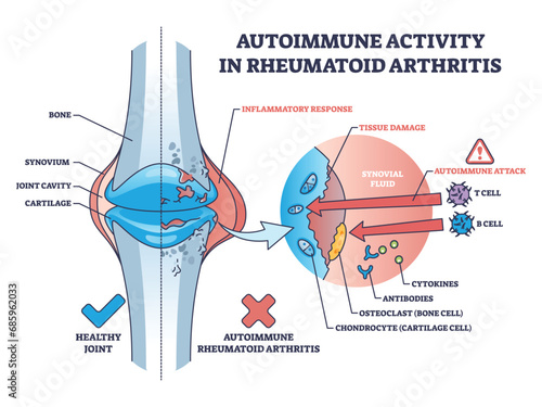 Autoimmune activity in rheumatoid arthritis skeletal disease outline diagram. Labeled educational scheme with body immune system attack to tissues with cells vector illustration. Bone inflammation. photo