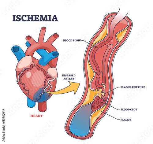 Ischemia as medical condition with blood flow blockage outline diagram. Labeled educational anatomy scheme with plaque rupture, blood clot and restricted or reduced flow to heart vector illustration.