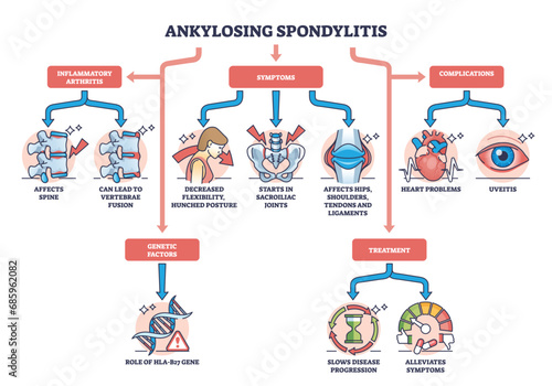 Ankylosing spondylitis as arthritis symptoms or complications outline diagram. Labeled educational medical scheme with spine inflammation illness and condition vector illustration. Back bone disease.
