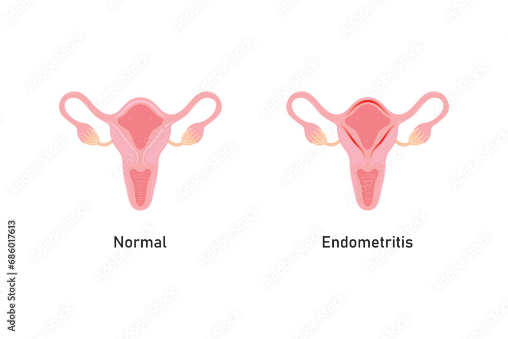 Endometritis Scientific Design. Vector Illustration. Endometritis Scientific Design. Vector Illustration.
