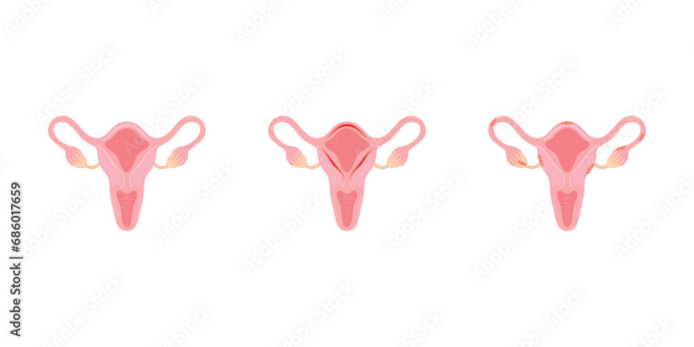 Fototapeta premium Endometriosis and Endometritis Scientific Design. Vector Illustration.