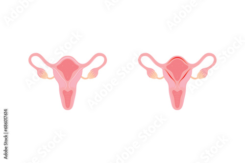 Endometritis Scientific Design. Vector Illustration.