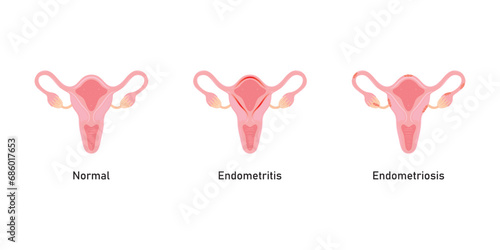 Endometriosis and Endometritis Scientific Design. Vector Illustration.