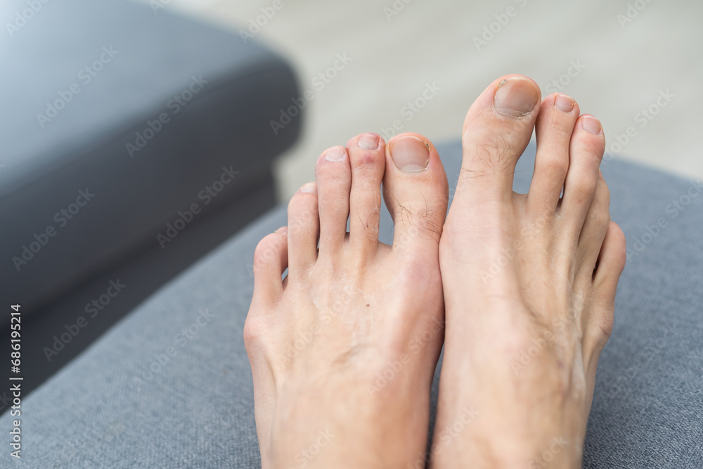 Fototapeta premium Young white male hairy foot with uncared toe nails
