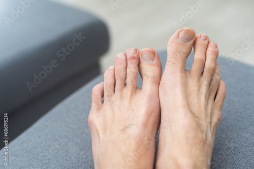 Young white male hairy foot with uncared toe nails photo