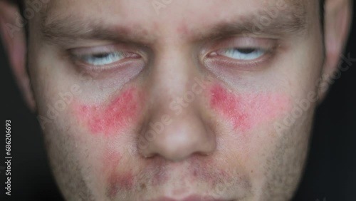 lupus disease, an autoimmune disease, symptoms in the form of redness on the face of a man. photo