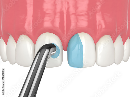 3d render of removing the mild acid as a part of bonding procedure